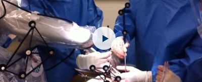 Total Hip Replacement using MAKO Robotic Assistance